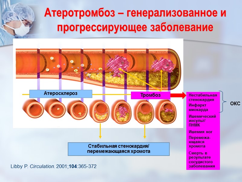 Атеротромбоз – генерализованное и прогрессирующее заболевание Libby P. Circulation. 2001;104:365-372 Атеросклероз Стабильная стенокардия/ перемежающаяся